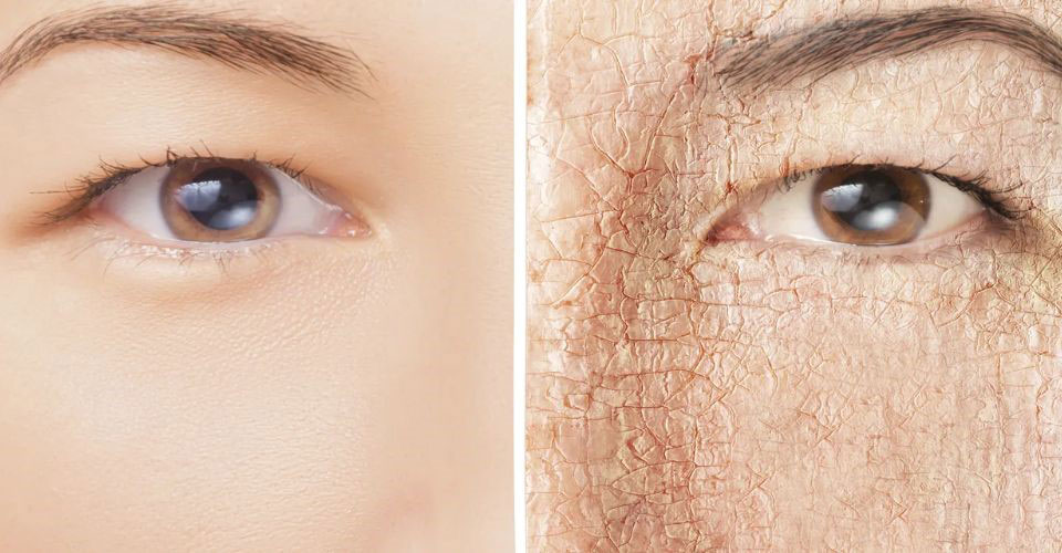 Understanding dry skin