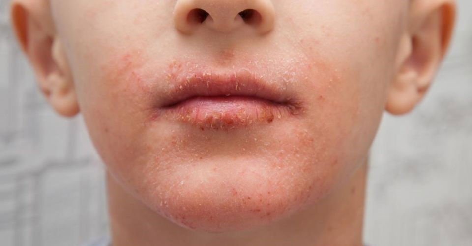 Some common symptoms of dry skin