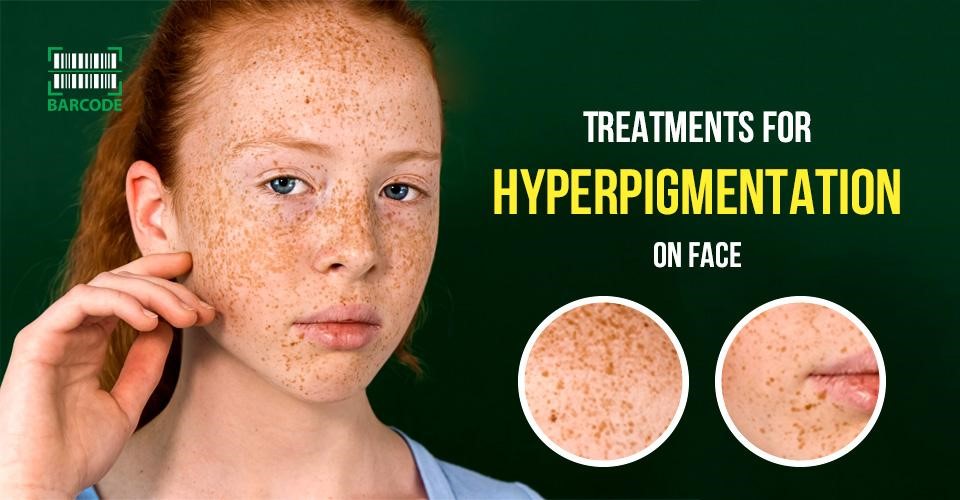 Treatments for hyperpigmentation on face