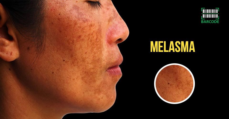 Melasma is one of the causes of hyperpigmentation